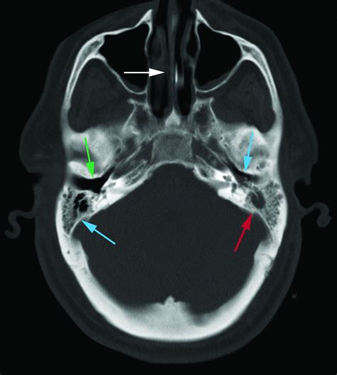 Radiographic Mastoid And Middle Ear Effusions In Intensive Care Unit