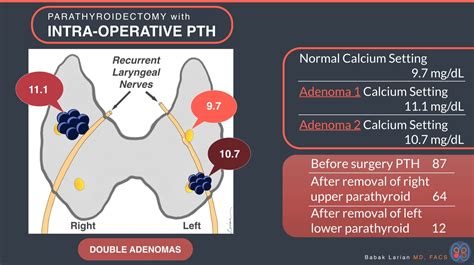 Parathyroidectomy With Intra Operative Pth Double Adenomas