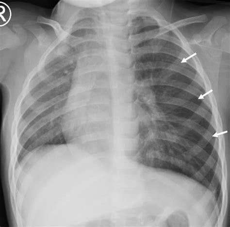 A pneumothorax occurs when air leaks into the space between your lung and chest wall. Cureus | Foreign Body Aspiration Presenting as ...