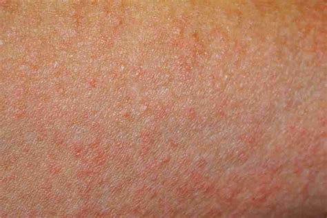 Anxiety Rash Causes Symptoms And Treatment Options