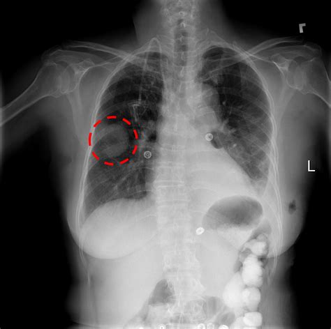 Nih Clinical Center Provides One Of The Largest Publicly Available Chest X Ray Datasets To