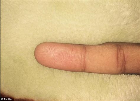 This is where users have reported a dent on their pinky finger from holding their smartphone too much. Have YOU got smartphone pinky? | Daily Mail Online
