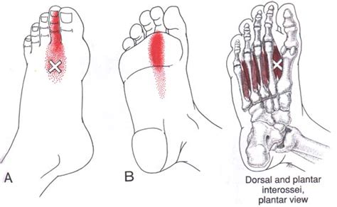 Interossei Of Foot The Trigger Point And Referred Pain Guide