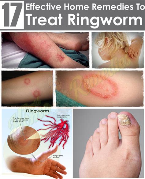 17 Herbal Remedies For Ringworm