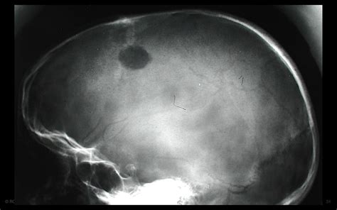 Eosinophilic Granuloma Skull Xr A Photo On Flickriver