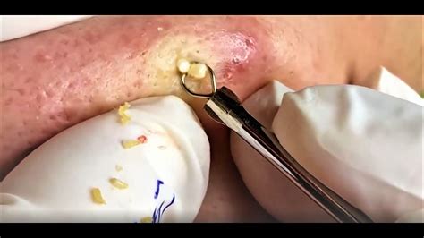 Cystic Acne Pimple And Blackheads Extraction Acne Treatment On Face At