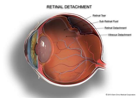 Back to Basics-Retinal Detachment - Sydney Ophthalmic Specialists