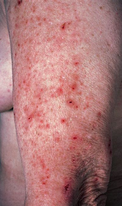 Liver Disease Itchy Skin Rash