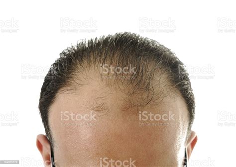 Closeup Of A Balding Mans Head Over A White Background Stock Photo