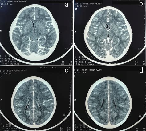 Contrast Enhanced Computed Tomography Cect Scan Of Brain No Focal
