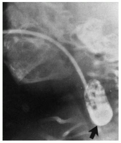 For example, in a blind fistula, only one end is open while the other end is. Esophagus: Normal Structures, Developmental Abnormalities ...