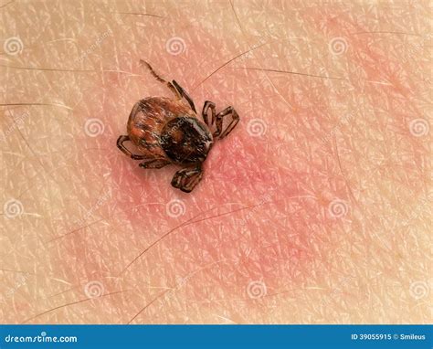 Tick Bite Stock Image Image Of Lyme Infection Protective 39055915