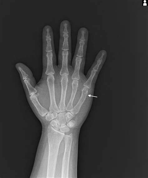 An X Ray Showing The Metacarpal Bone Fracture At Right Fifth Bone Of