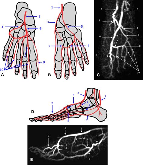 Illustration Of Pedal Artery Anatomy A B D And MIP Images Of FS FBI