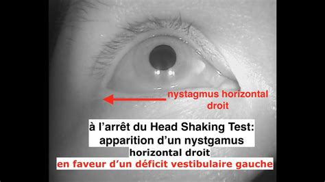 Head Shaking Test Nystagmus Droit Déficit Vestibulaire Gauche Youtube