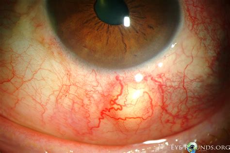 Episcleritis Eye