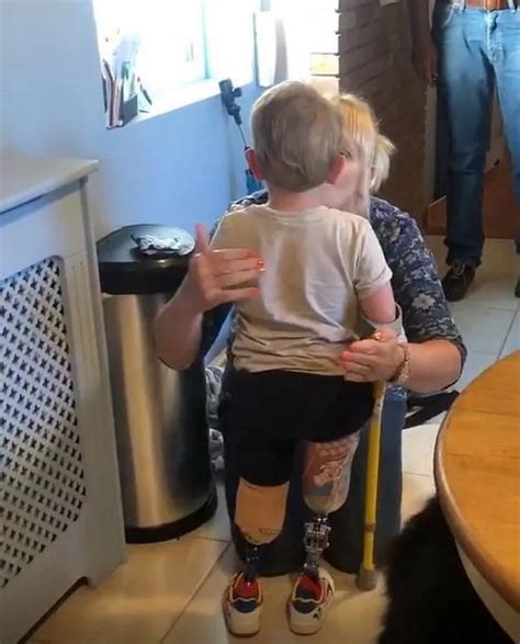 Watch Toddler Walk For First Time After Losing Legs To Sepsis