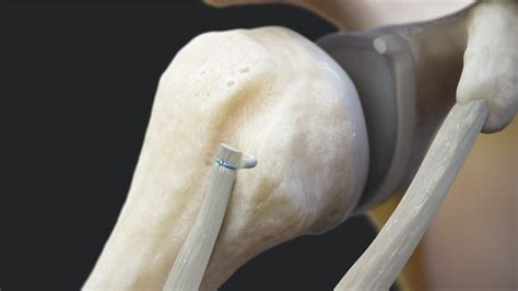 Arthrex Knotless Fibertak® Biceps Implant System For Proximal Biceps
