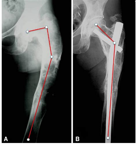 A B A Type 4 Femoral Deformity Corrected By Multiple Osteotomies And