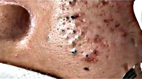 Juicy Blackheads 2023 The Essential Guide To This Trending Topic Exposed The Secrets You Cant Miss