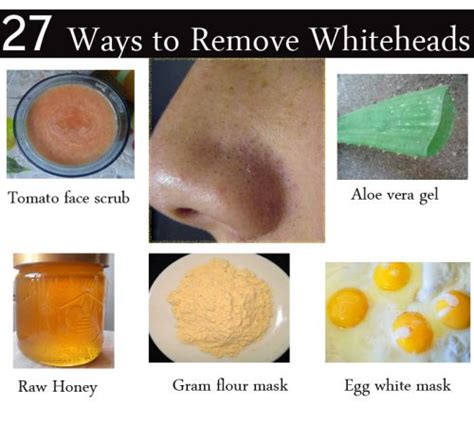 How To Get Rid Of Whiteheads On Nose At Home 27 Methods Included