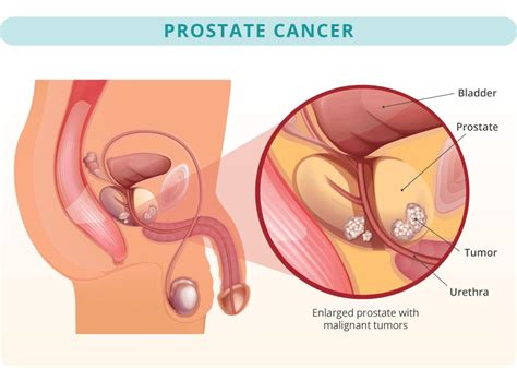 Prostate Cancer Orange County Urologic Institute