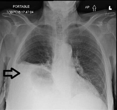 Diaphragmatic Hernia In Adults Slidesharedocs