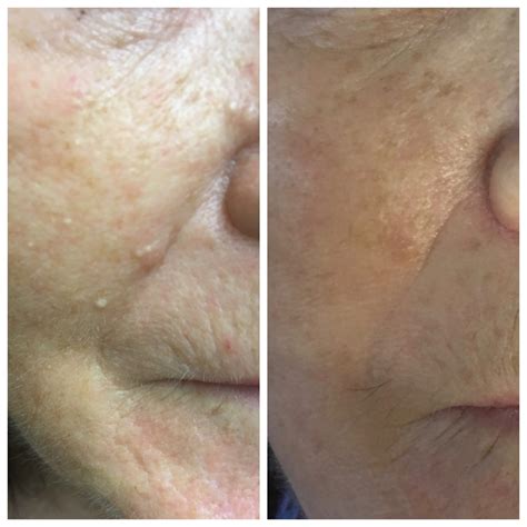 Before And After General Milia Removal Skin Essentials By Mariga