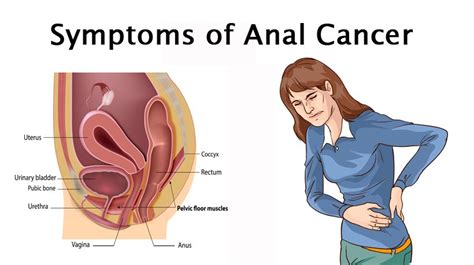 Rectal cancer may show no obvious symptoms in early stages. 6 Symptoms That Could Indicate Anal Cancer - WomenWorking