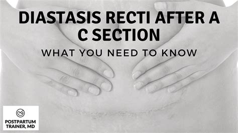 Diastasis Recti After A C Section What You Need To Know Postpartum