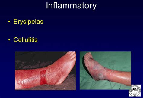 Erysipelaandcellulitis الحمرة أو التهاب الجلد