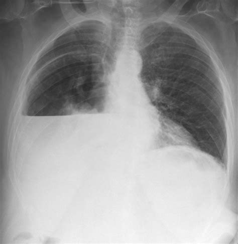 Giant Hiatal Hernia Beware Of The Supine Icu Chest X Ray Bmj Case