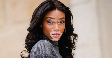 Winnie Harlow Clears The Air About Americas Next Top Model