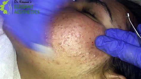 Comedones Removal Part 1 By Popping King Drlalit Kasana Youtube