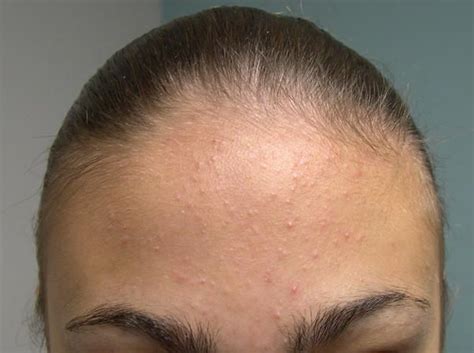 Bumps On Forehead Small Pimples On Face Skin Bumps On Face Small