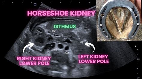 Ultrasound Male Baby Horseshoe Kidney Youtube