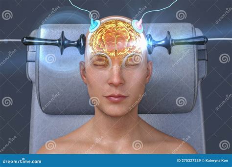 Electroconvulsive Therapy Ect A Treatment Involving The Use Of