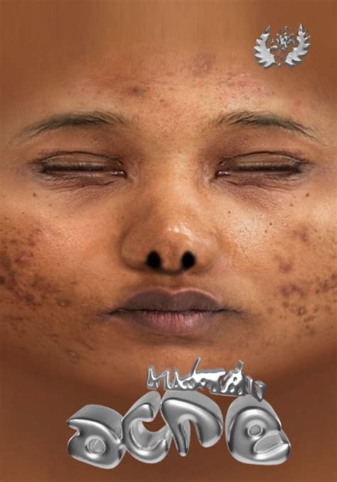 Acne Skin 🌀 Kikovanity Sims 4 Cc Skin Sims 4 Sims 4 Body Mods