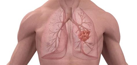 Lungenemphysem Ist Es Lebensgef Hrlich