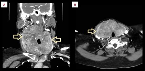 A A Coronal Ct With Contrast Showing Heterogeneous Enhanced Thyroid