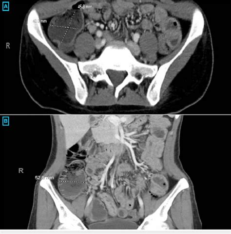 Ct Of The Abdomen And Pelvis Terminal Ileitis Evidenced By An