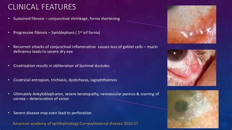 Ocular Cicatricial Pemphigoid Stevens Johnson Syndrome Toxic Epider