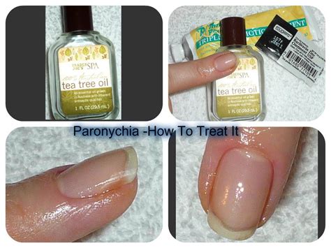 Acute Chronic Paronychia Treatments Tea Tree Oil Home Treatment