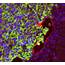 Lymphatic Endothelial Cells Promote Melanoma To Spread – BIOENGINEERORG