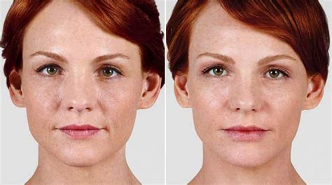 Juvederm Facial Filler Contour Dermatology