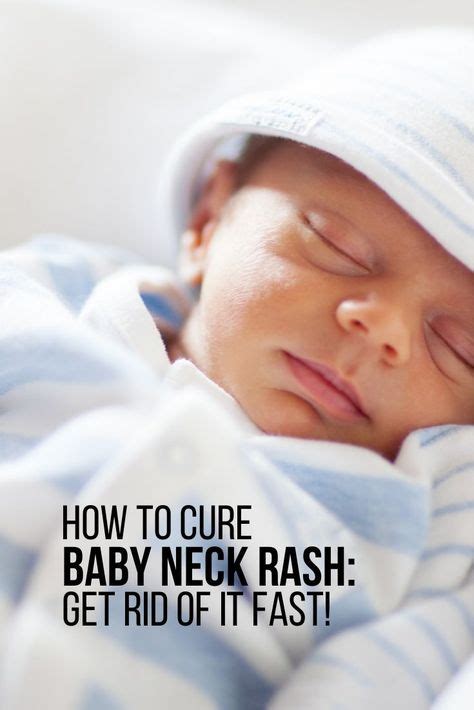 How To Cure Baby Neck Rash Get Rid Of It Fast Baby Neck Rash Rash