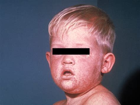 Measles Has Infected 84 People In 14 States This Year