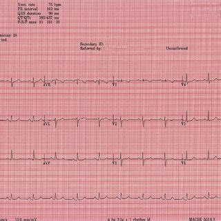 Twelve Lead Electrocardiogram Showing Sinus Rhythm With An Incomplete