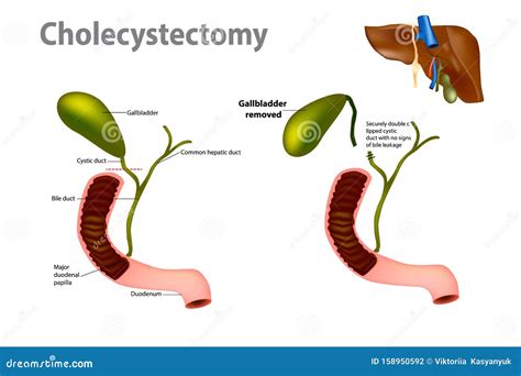 Gallbladder Removal Surgery Stock Vector Illustration Of Operation