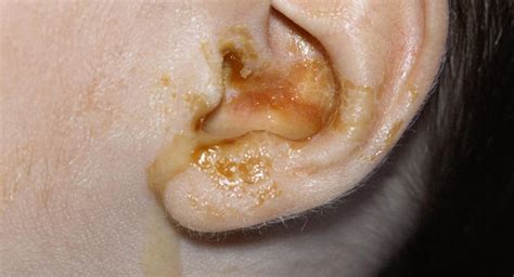 Ear Infections In Babies Babycenter Canada